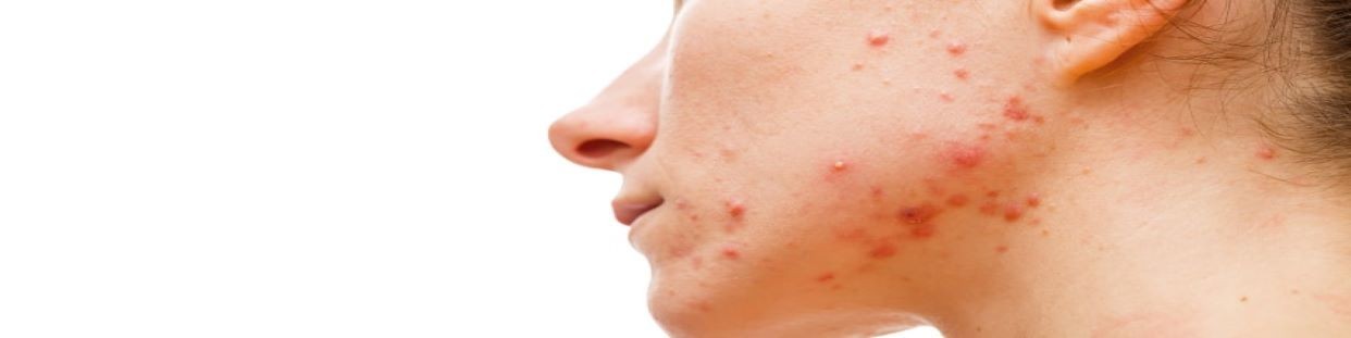Acne: Descubra as melhores marcas para a pele acneica