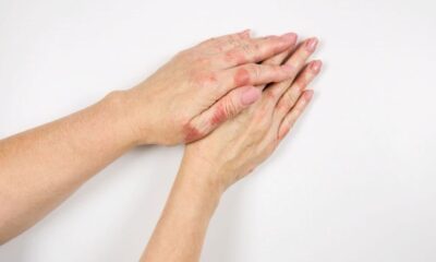 Higiene mãos eczema