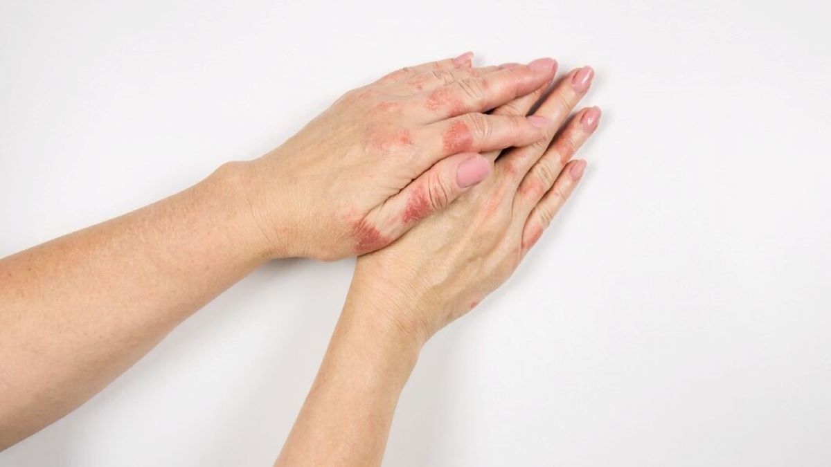 Higiene mãos eczema
